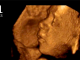 States With Unlimited Abortions Kill So Many Babies They’re Below Replacement Rate
